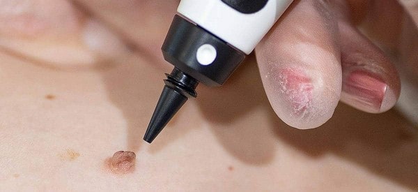 After Skin Tag Removal Walham Green