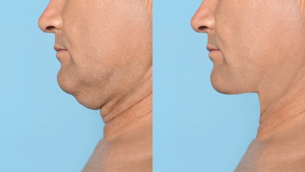 Which Non-Surgical Treatments Work Best for Jowls and Loose Skin Walham Green?