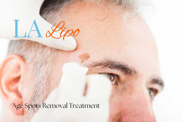 What Are the Most Effective Treatments for Age Spots Walham Green?
