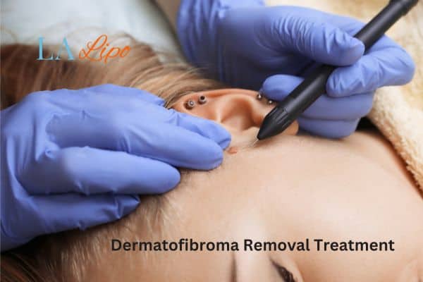 Dermatofibroma Removal Treatment Walham Green