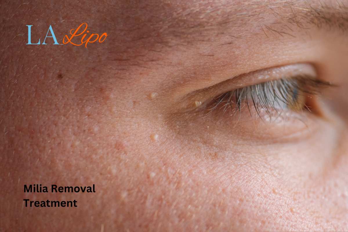 Cryopen Milia Removal: Is It the Easiest and Safest Option Walham Green?