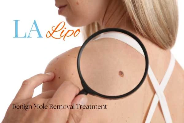 Woman having her inspection of blemish before mole removal Walham Green