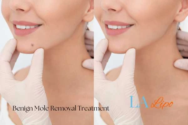 woman's before and after mole removal Walham Green results