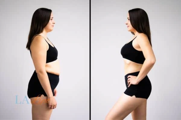image of woman before and after results of LA-EMS Body Sculpting Walham Green to help treat Diastasis recti