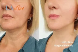 hi-fu for wrinkles Walham Green before and after results