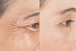 Before and after results of woman - HI-fu wrinkles reduction treatment Walham Green