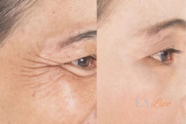 Before and after results of woman - HI-fu wrinkles reduction treatment Walham Green