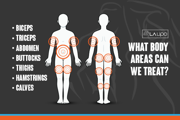 Graphic to show areas you can have LA-EMS Body Sculpting Walham Green treatment.