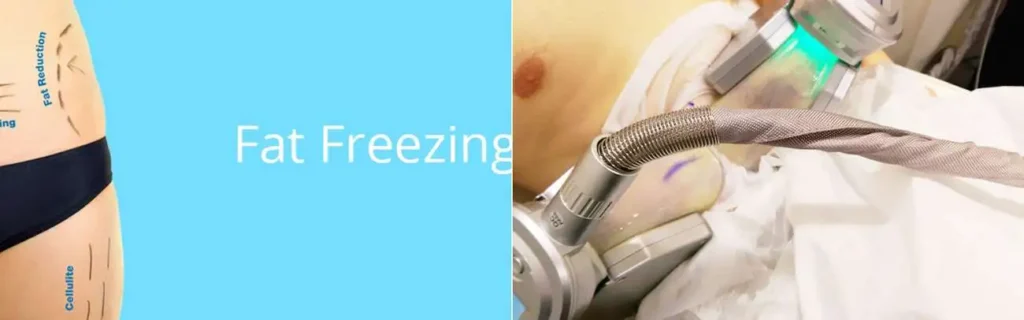 multi areas of a persons body having coolsculpting Walham Green treatment