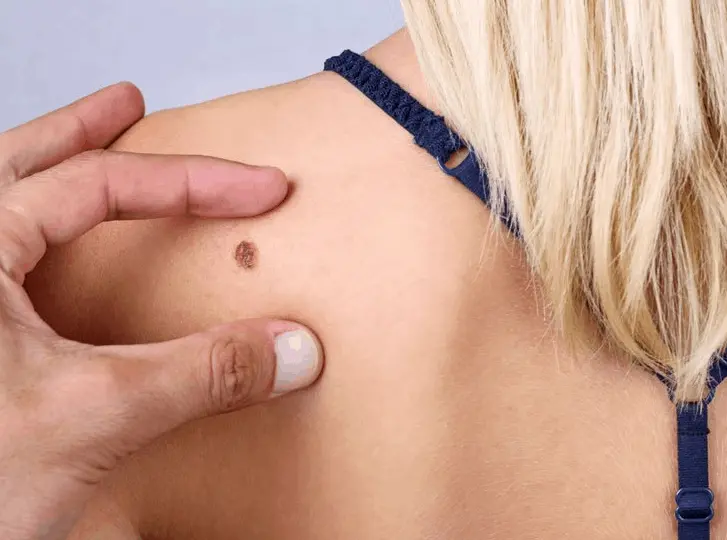 woman having mole removal Walham Green consultation before treatment.