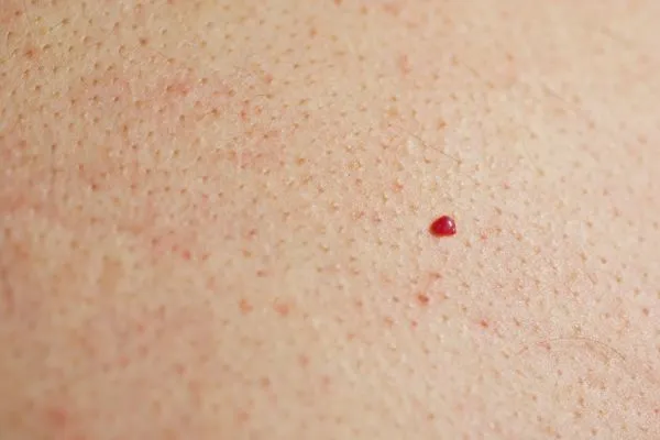 close up of a cherry angioma Walham Green