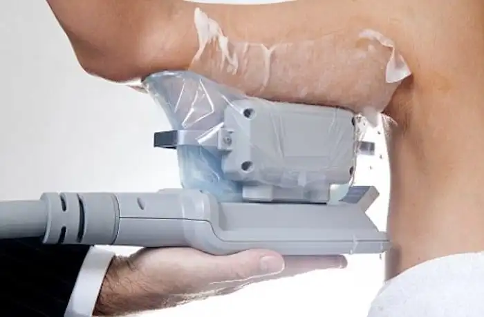 Picture of fat freezing Walham Green on the upper arms.