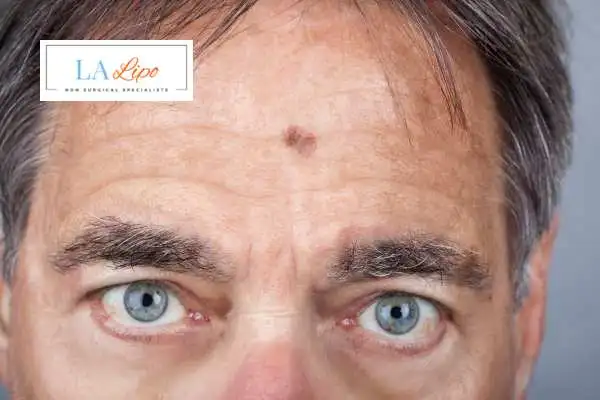 Solar Lentigo Removal Walham Green image of man with mark on his forehead