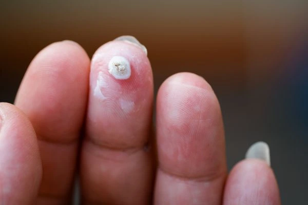 wart on person finger - cryotherapy to treat from LA LIPO Walham Green