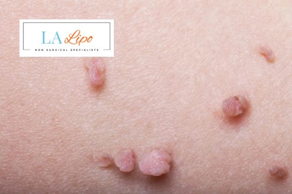 Does cryopen skin tag removal Walham Green hurt? Find out now call our team today!