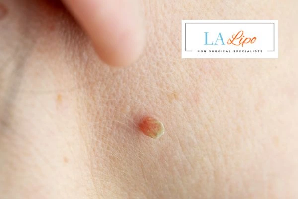 Book skin tag removal Walham Green today speak to our team now!