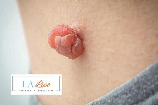 Interested in skin tag removal Walham Green? Concerned about the pain? Find out more today!