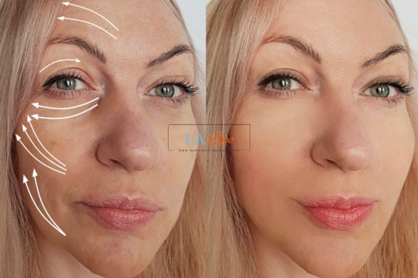 Morpheus 8 results Walham Green face lift.