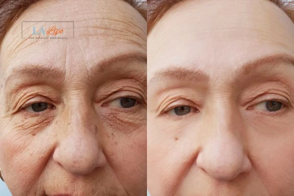 The powerful benefits of Morpheus8 Treatment Walham Green - Call Our team today!