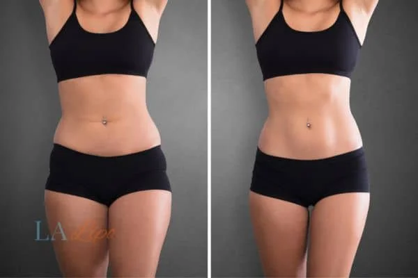 before and after results of non-surgical treatment to help a woman's body image and mental health Walham Green
