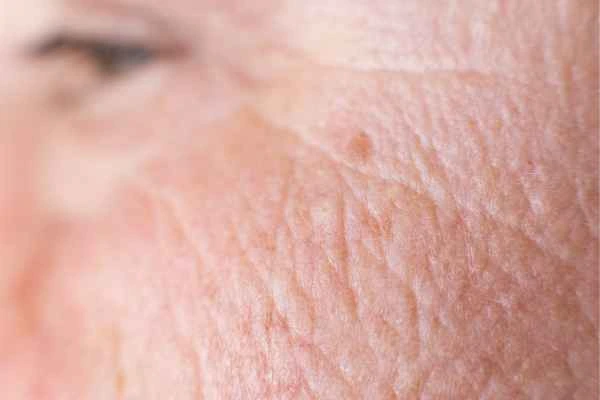 close up picture of a woman's face showing an age spot Walham Green