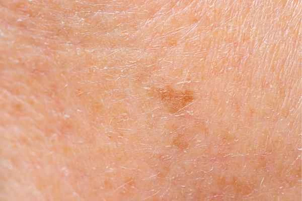 close up picture of age spots Walham Green