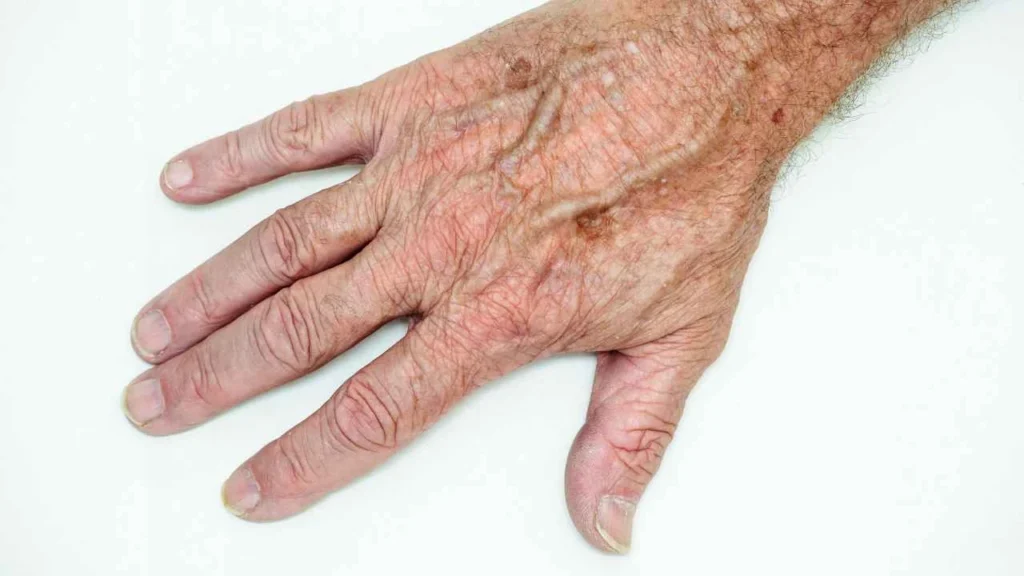 Male hand showing age spot Walham Green