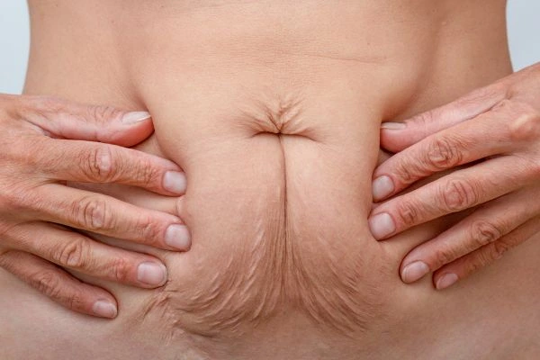 Image of a woman's stomach with loose skin - example of skin tightening Walham Green options