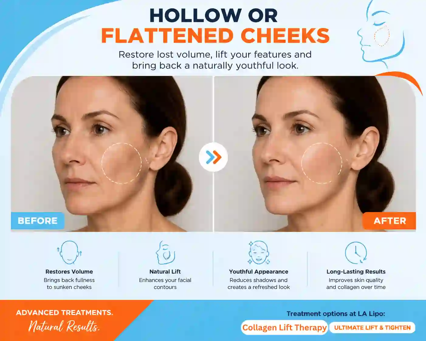 Sign #4: Hollow or Flattened Cheeks Walham Green
